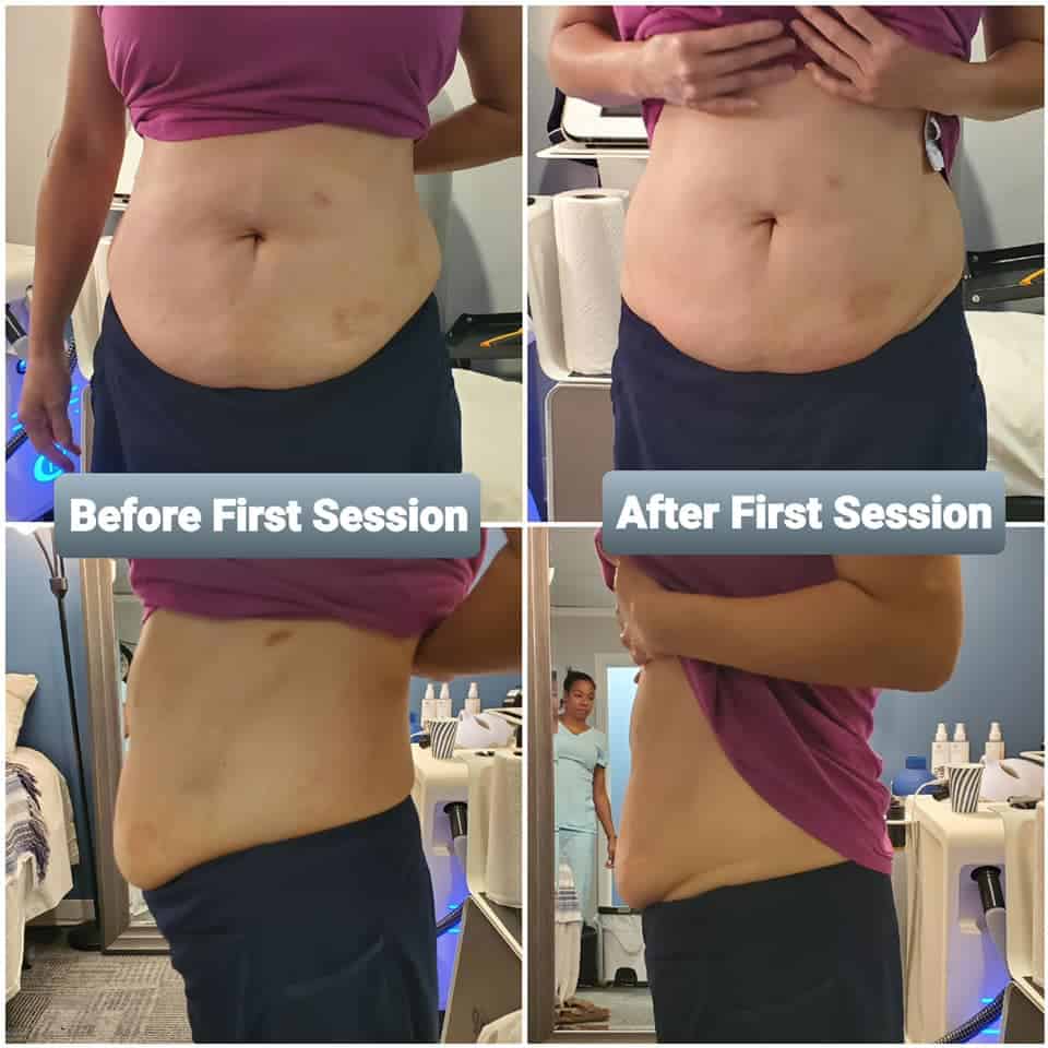 Cryo Slimming Treatment