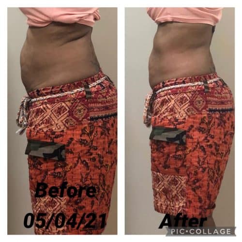 60 yr old women after 1 treatment lost one and half inches